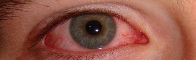  العلاجات المنزلية لحرقة العين من الحساسية  P_521i0erk1