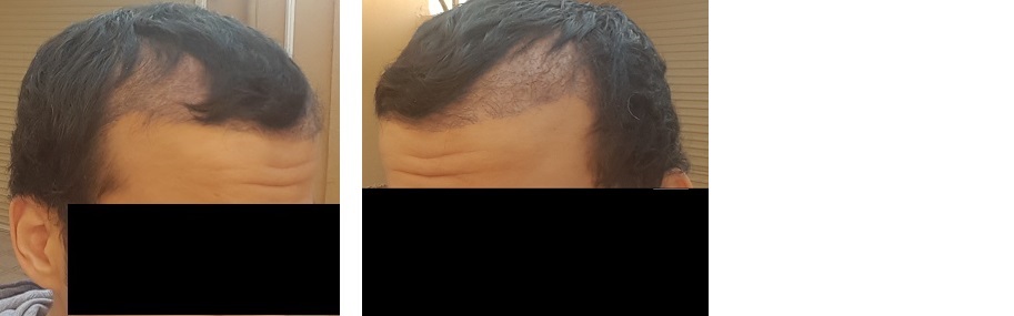 تجربة 3 اصدقاء لزراعة الشعر في تركيا في وقت واحد ايست اثيكا P_5730hhx52